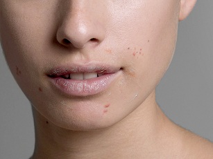 Imagen Tratamientos anti-acne